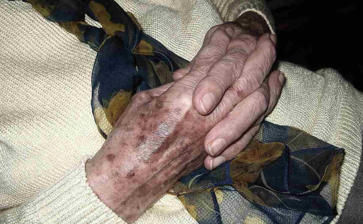 Macchie sulla pelle, con l’avanzare dell’età sono inevitabili | Ma c’è un modo per schiarirle del tutto: serve solo un po’ di pazienza